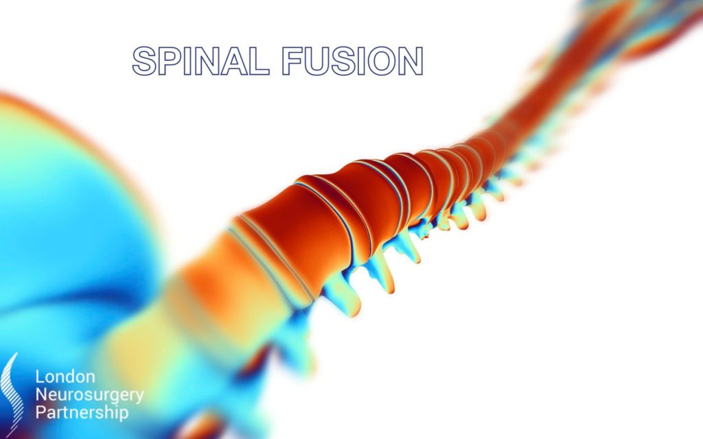 Spinal fusion