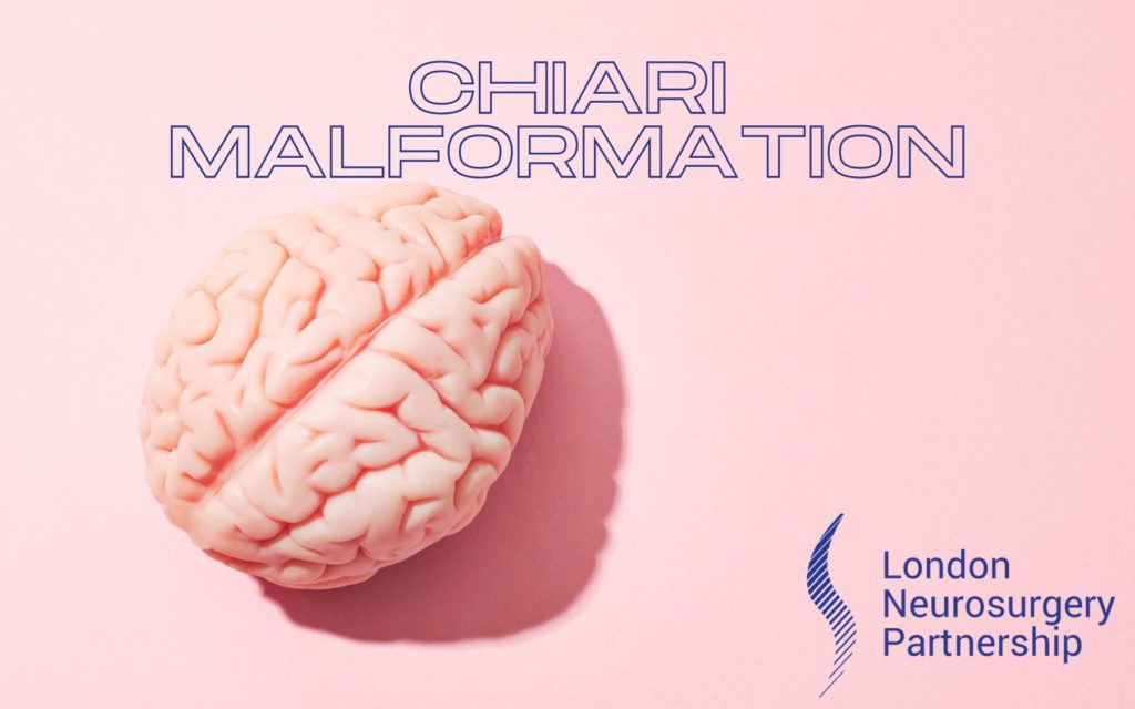 chiari malformation london neurosurgery partnership