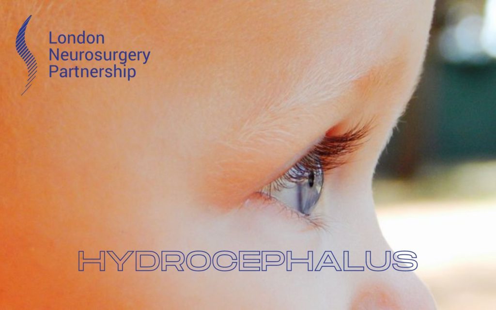 Hydrocephalus london neurosurgery partnership