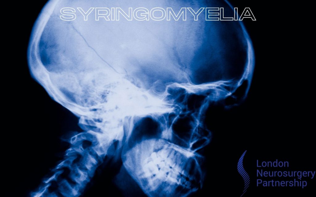 syringomyelia london neurosurgery partnership