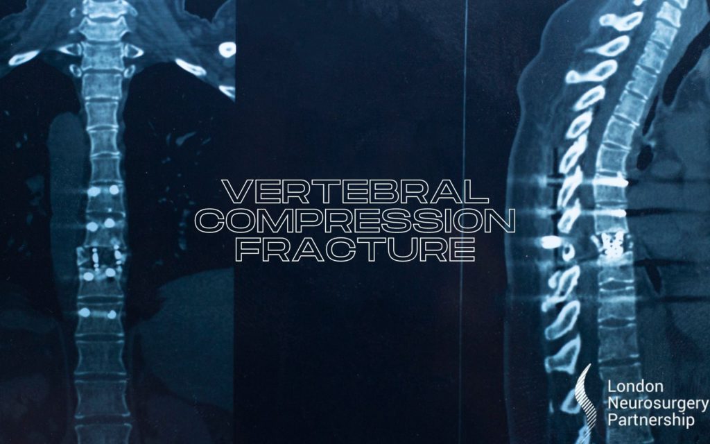 vertebral compression fracture