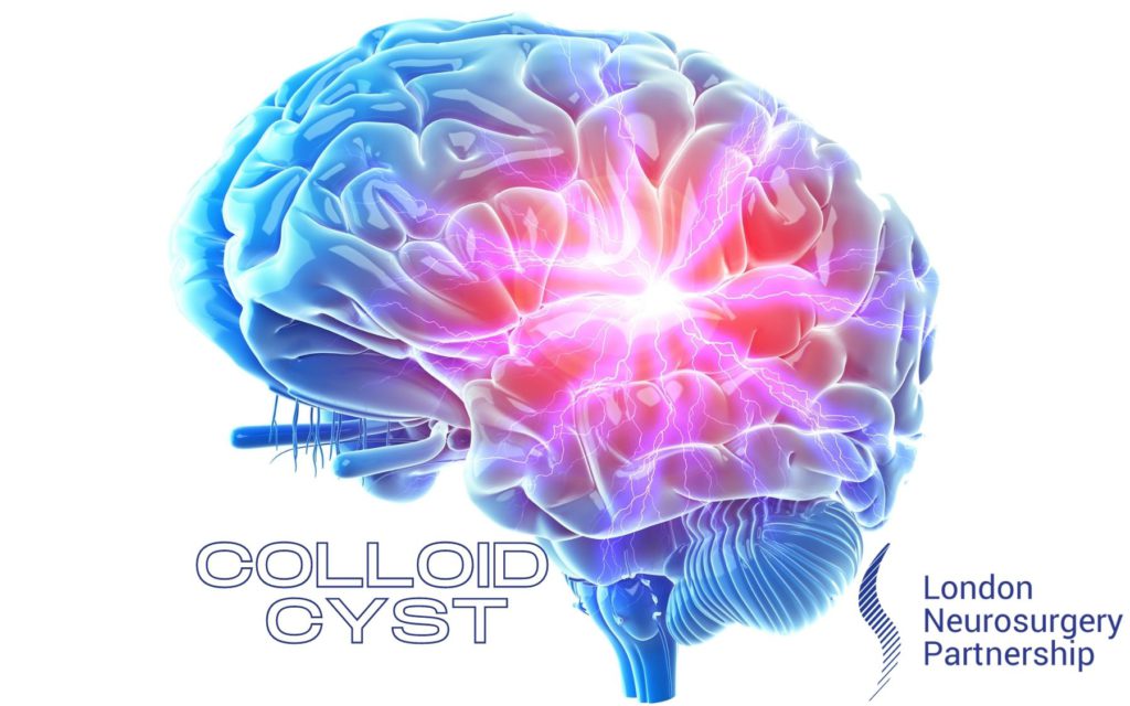 colloid cyst london neurosurgery partnership