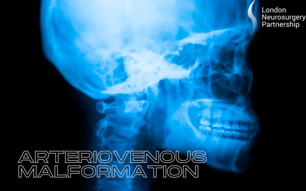 AVM Arteriovenous malformation