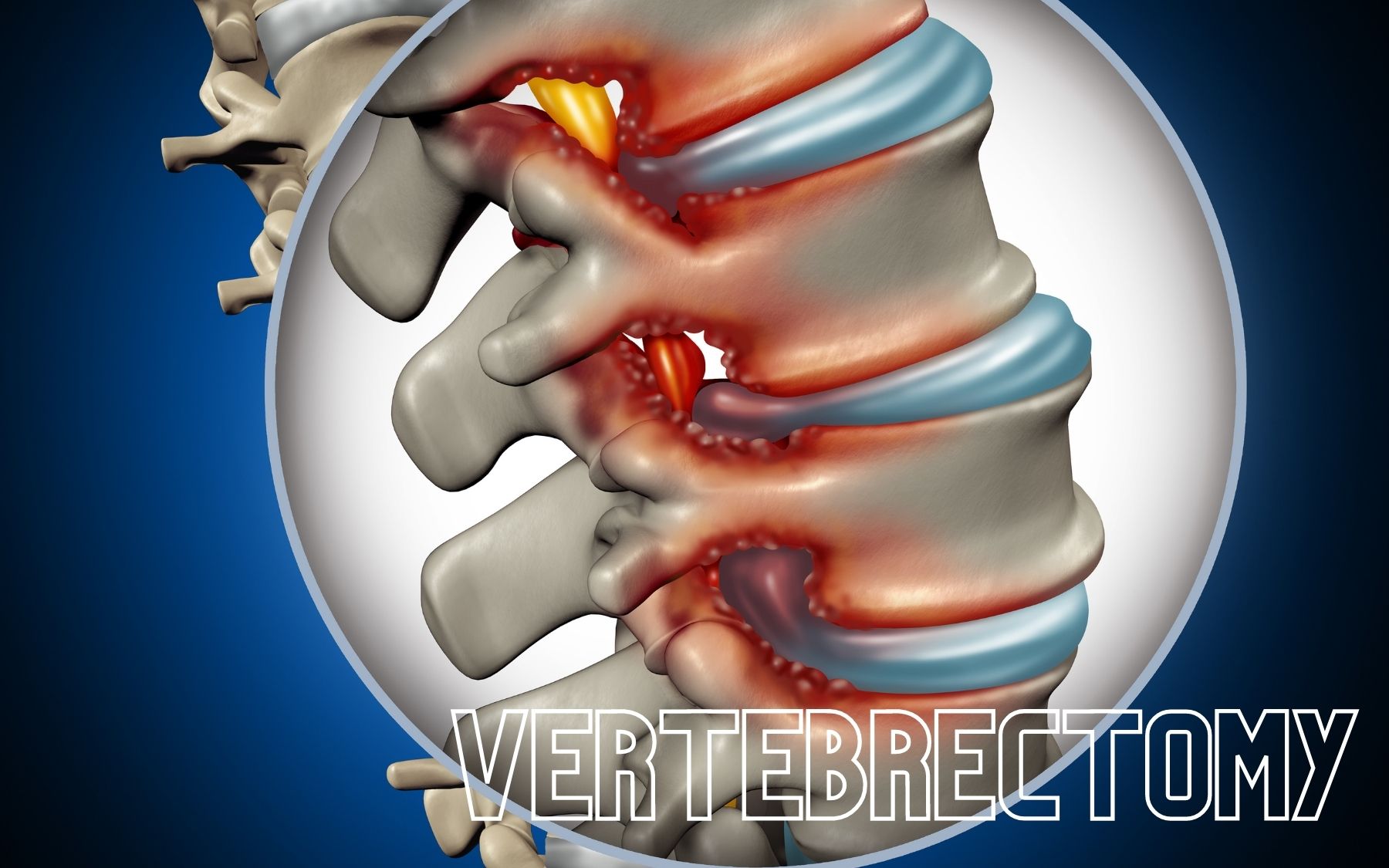 Vertebrectomy
