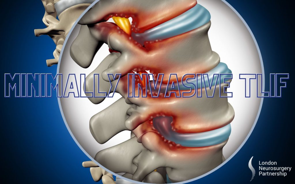 minimally invasive TLIF